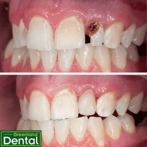 Aesthetic composite restoration