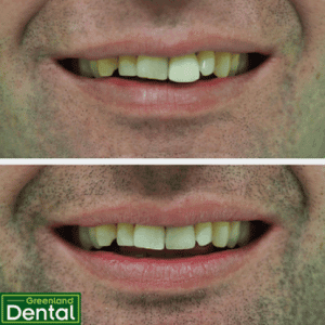 Crown replacement + in chair whitening