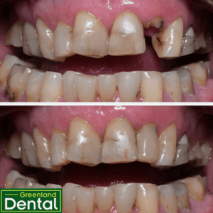 Post supported direct restoration