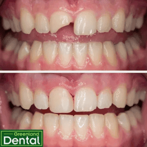 Composite restoration to restore broken tooth