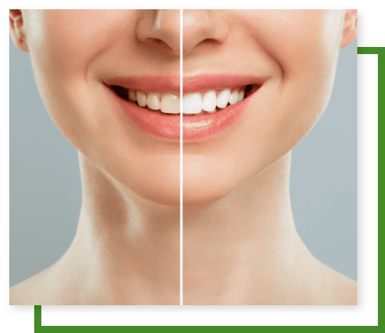 Professional tooth whitening