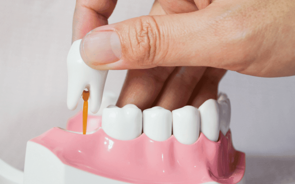 What Are Wisdom Teeth